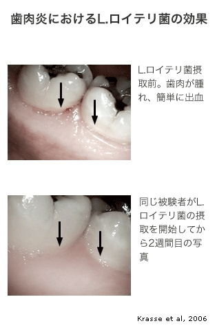 歯周病におけるロイテリ菌の効果がうかがえる比較写真